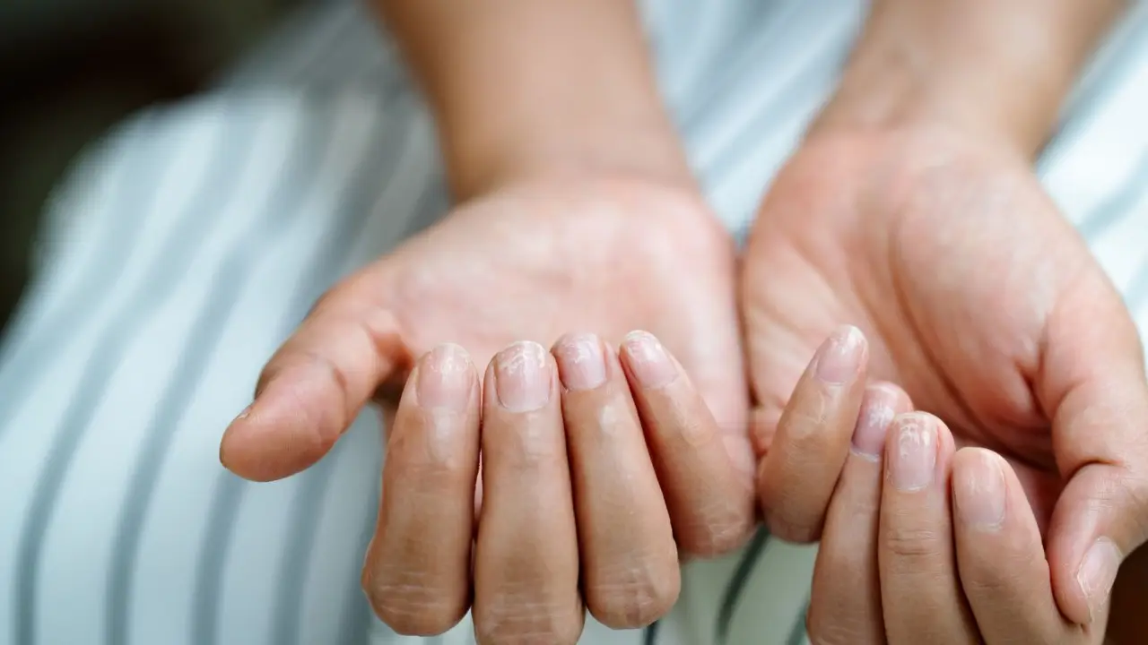 Soffri di psoriasi? Ecco il metodo naturale più efficace per fermare le placche